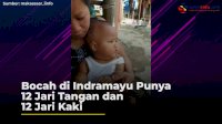 VIDEO: Bocah di Indramayu Punya 12 Jari Tangan dan 12 Jari Kaki