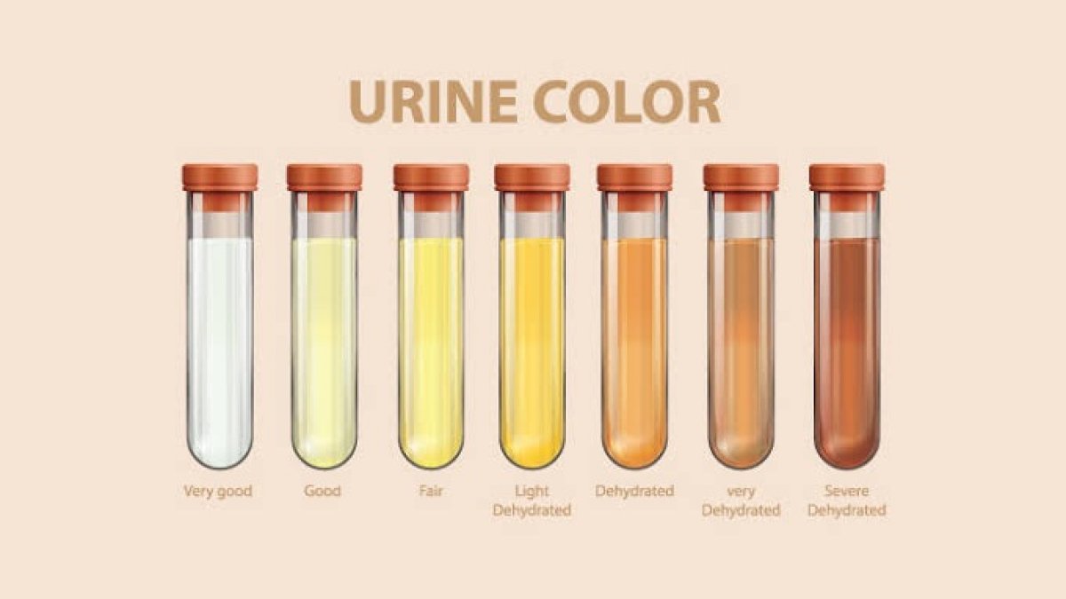 Yuk Kenali Penyakit dalam Tubuh Lewat Warna Urine